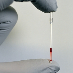 Sickle cell test sample