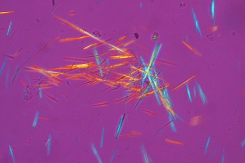 Needle-like gout crystals