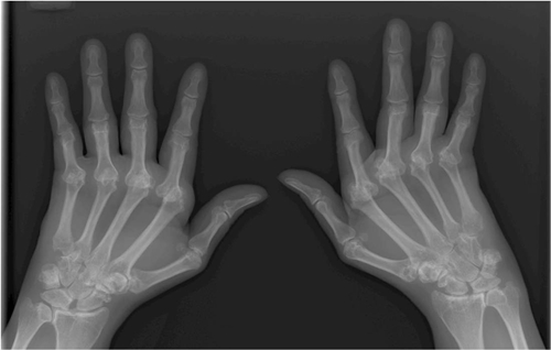 X-ray f hands with rheumatoid arthritis