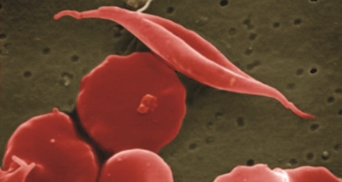Red blood cells with sickle cell disease