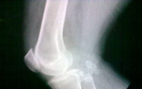 Knee X-ray