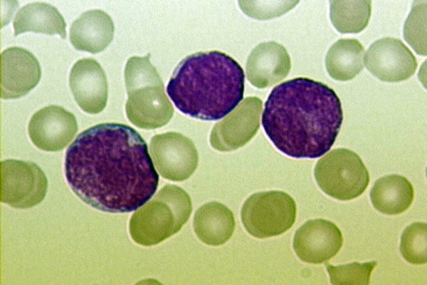 Acute lymphoblastic leukemia cells