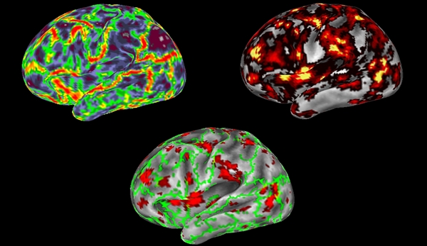 Functional MRI images of brain
