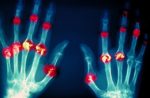 Nanoscale Sponges Deliver Rheumatoid Arthritis Treatment