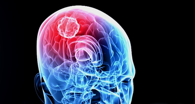 Brain tumor illustration