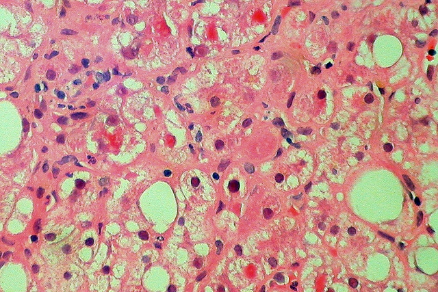 Damaged liver cells