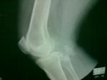 Knee joint X-ray