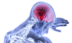 Stroke Found in More Young Adult Covid-19 Patients