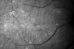 DARC retinal scan