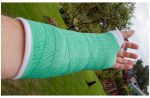 Small Biz Grant Funds Wrist Fracture Adhesive