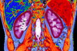 MRI scan of kidneys
