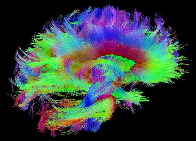 MRI image of white matter fibers in the brain